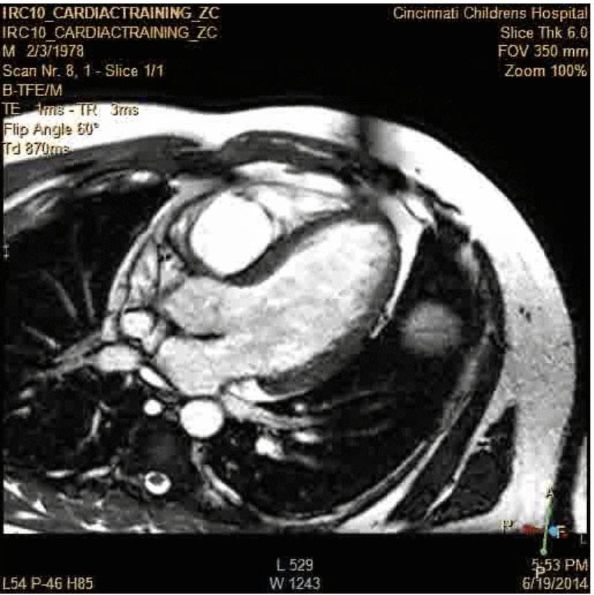 MRI of a heart